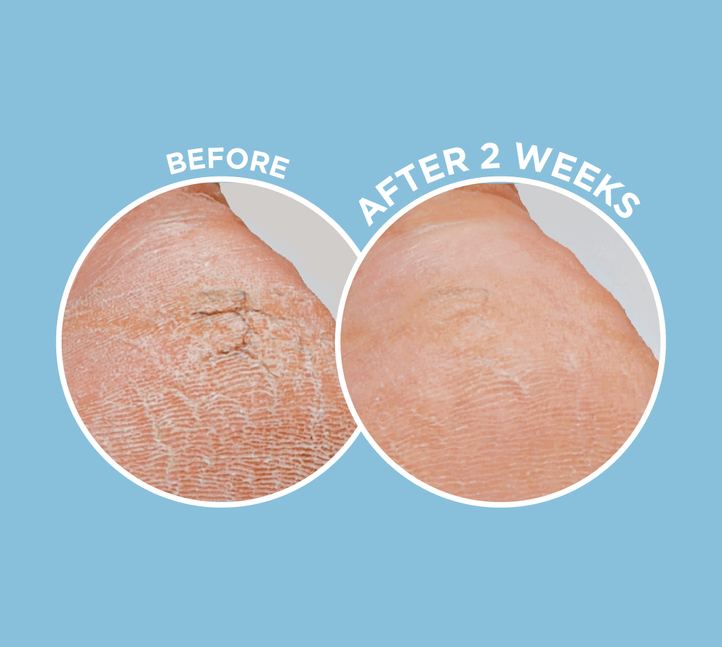 Dermal Therapy 足跟修護膏 70g
